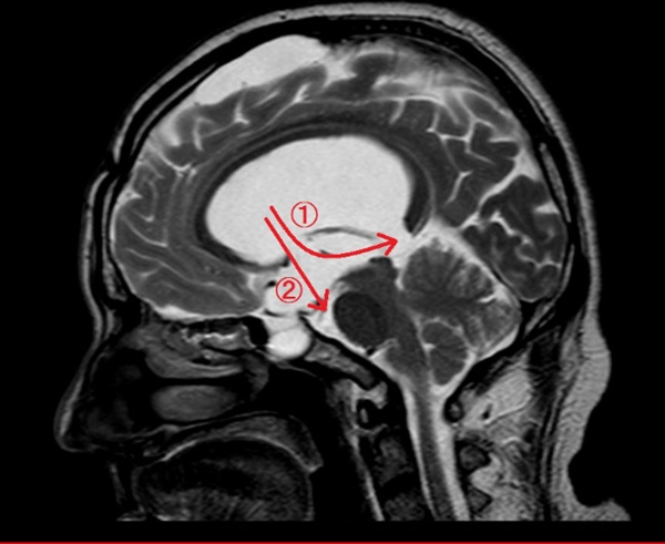 髄液の流れを神経内視鏡手術