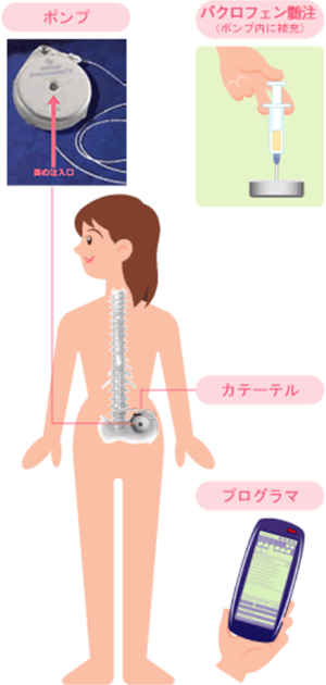 バクロフェン髄注療法