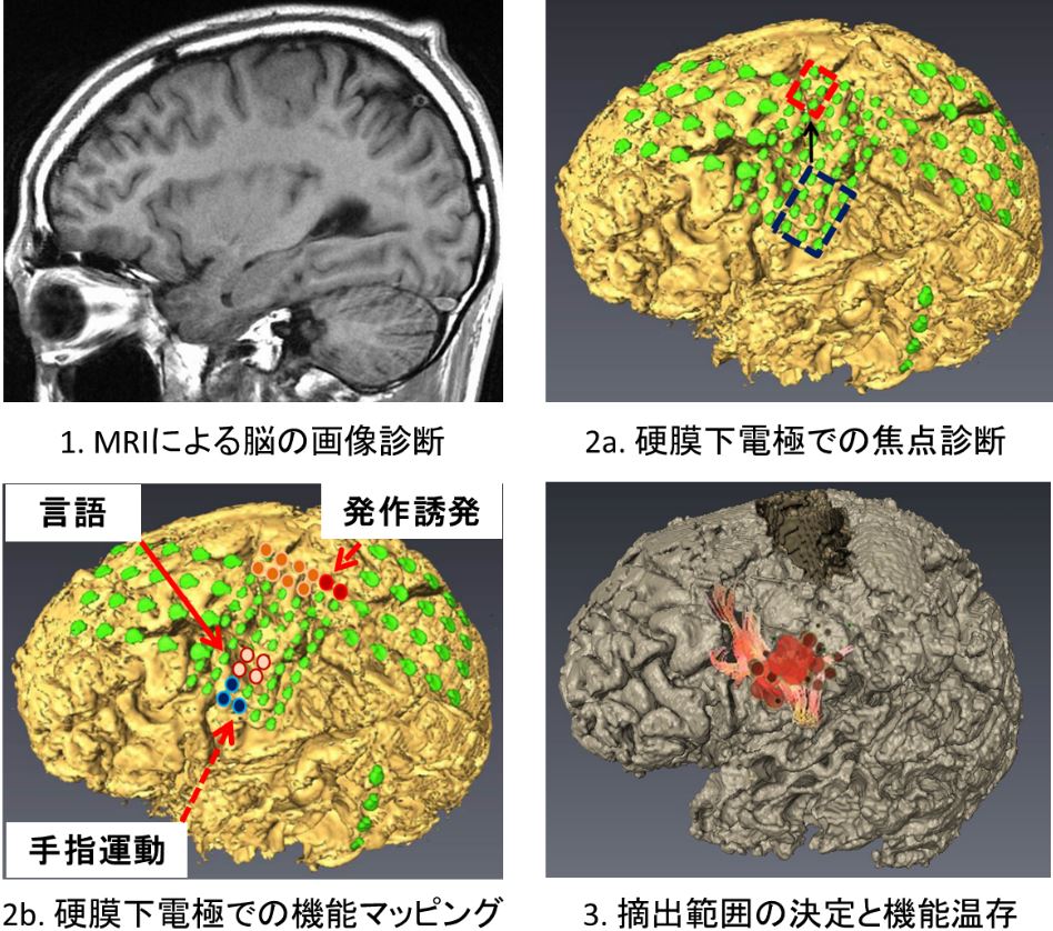 硬膜下電極の焦点診断と脳機能マッピング