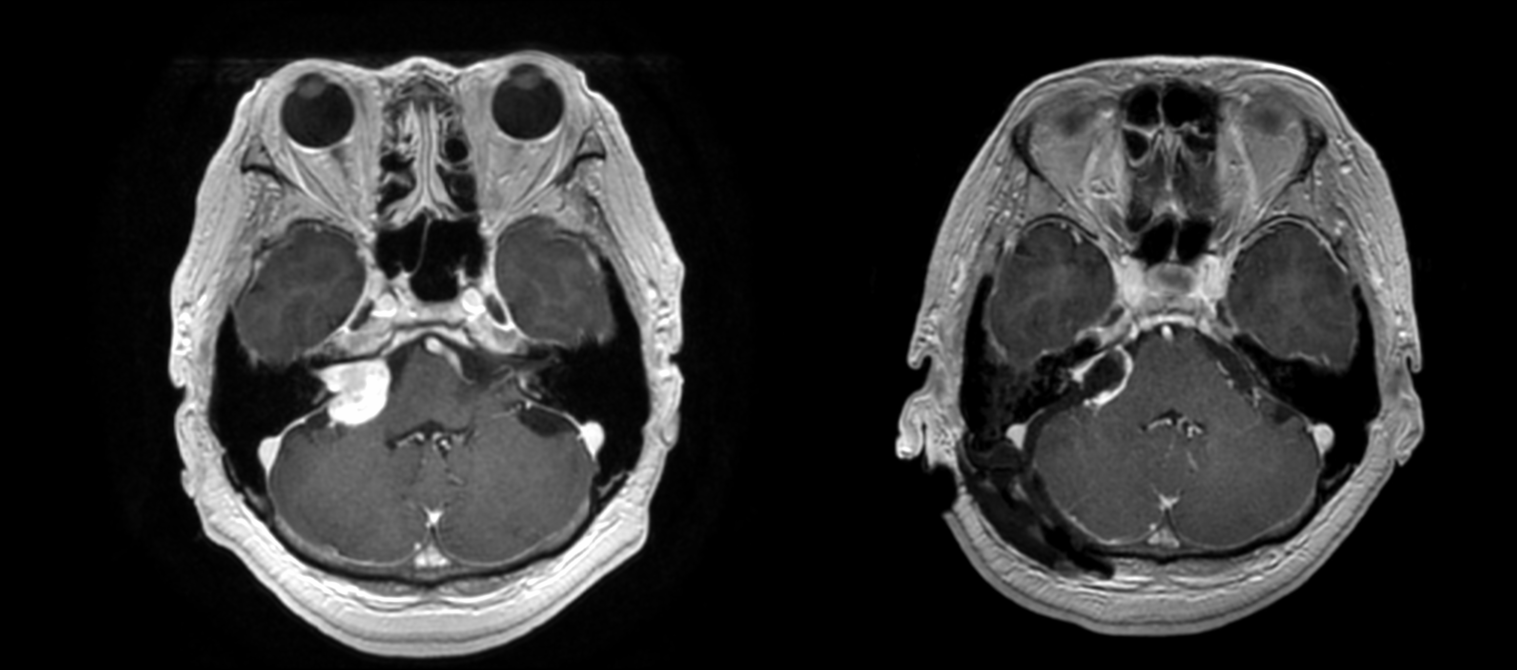 脳腫瘍はどのように治療されますか?