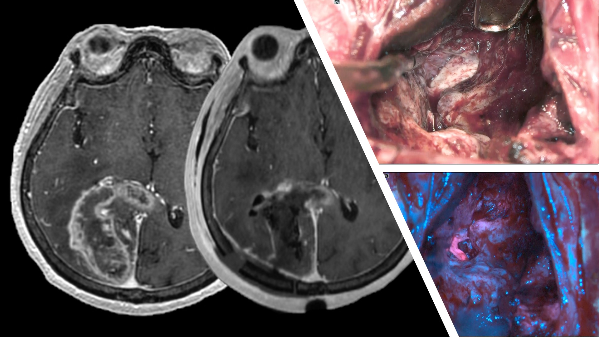 膠芽腫（Glioblastoma: GBM） – 旭川医科大学脳神経外科学講座