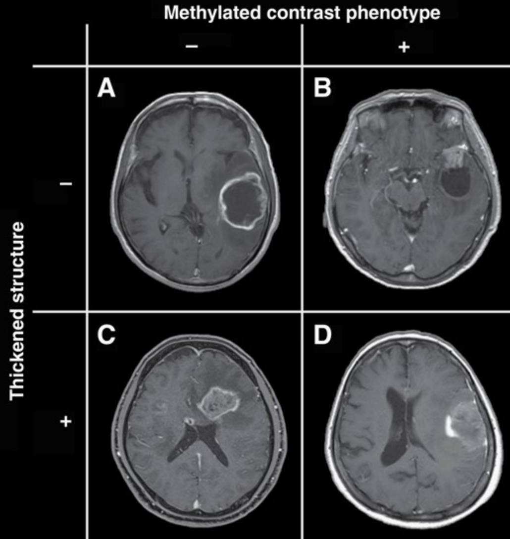 当講座の真田隆広先生が研究成果をNeuro-oncology Advancesに発表しま