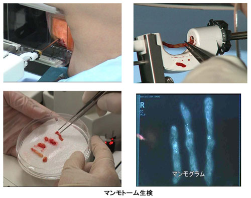 マンモトーム生検