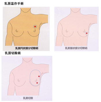 乳房温存手術・乳房切除術