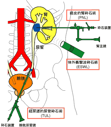 尿路結石に対する砕石法（PNL, ESWL, TUL）