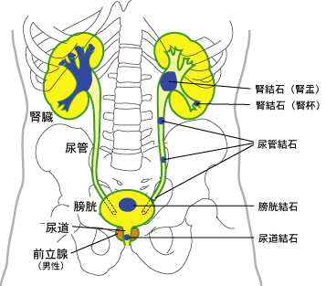 結石の種類