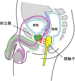 経直腸超音波検査