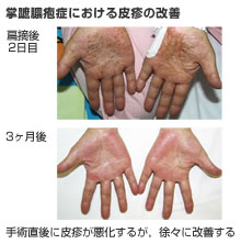 図2 掌蹠膿疱症における皮疹の改善