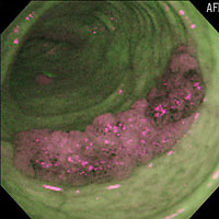 光デジタル法により，大腸癌がマゼンタ色に光る。